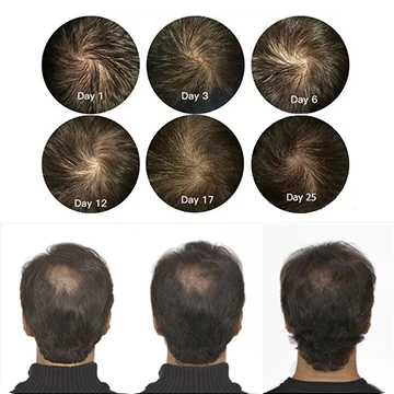 Žaliavos nuo plaukų slinkimo